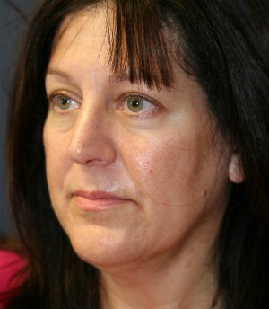 Face and Neck Lift San Diego - before - oblique