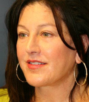 Face and Neck Lift San Diego - after - oblique