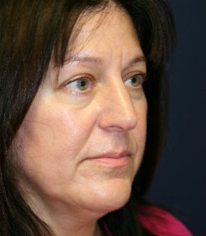 Face and Neck Lift San Diego - before - side