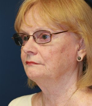 Neck Lift San Diego 24 - before - oblique