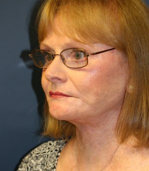 Neck Lift San Diego 24 - after - oblique
