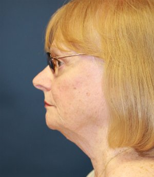 Neck Lift San Diego 24 - before - front