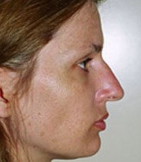 Rhinoplasty Case 10 - before - front