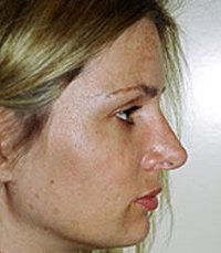 Rhinoplasty Case 10 - after - front