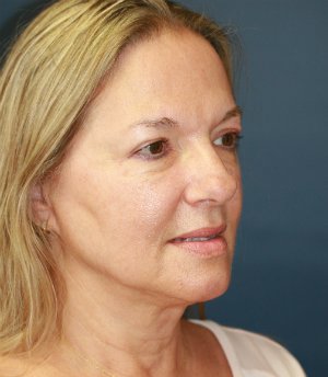 Liposuction Jowls and Neck - after - oblique