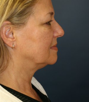 Liposuction Jowls and Neck - before - side