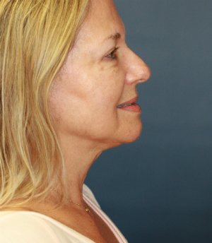 Liposuction Jowls and Neck - after - side