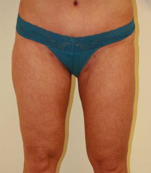 Thinner Thighs - Longer Legs - after - front