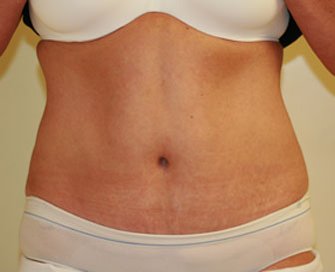 Tummy Tuck Case 15 - after - front