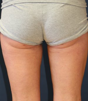 Thigh Gap San Diego - after - front