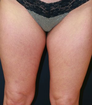 Thigh Gap San Diego - before - back