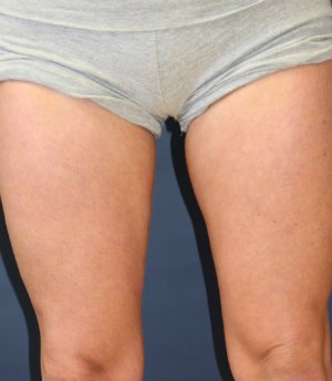 Thigh Gap San Diego - after - back