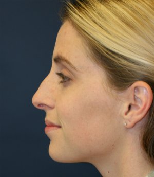 Rhinoplasty (Nose) San Diego - before - front