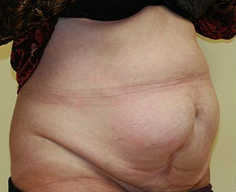 Tummy Tuck Case 15 - before - angle