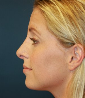 Rhinoplasty (Nose) San Diego - after - front