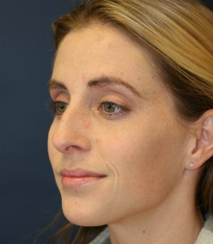 Rhinoplasty (Nose) San Diego - before - oblique