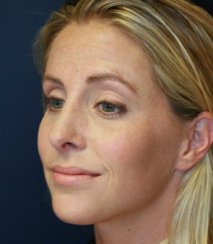 Rhinoplasty (Nose) San Diego - after - oblique