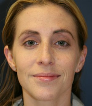 Rhinoplasty (Nose) San Diego - before - side