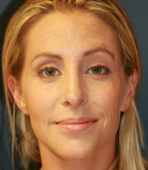 Rhinoplasty (Nose) San Diego - after - side