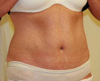 Tummy Tuck Case 15 - after - angle