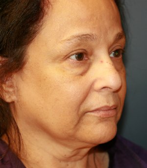 Eyelid Rejuvenation San Diego 74 - before - oblique