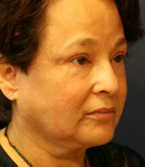 Eyelid Rejuvenation San Diego 74 - after - oblique
