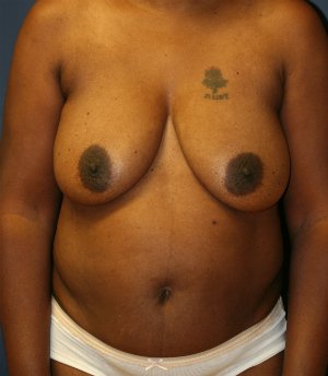 Breast Lift San Diego 23 - before - side