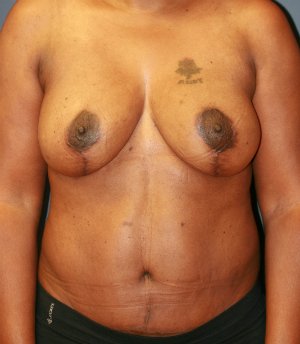 Breast Lift San Diego 23 - after - side