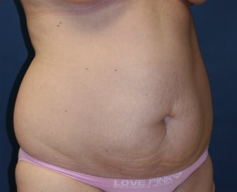 Tummy Tuck San Diego 57 - before - oblique