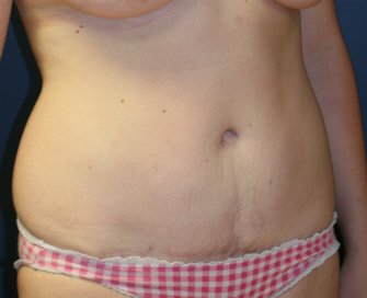 Tummy Tuck San Diego 57 - after - oblique