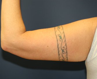 Arm Lift San Diego 12 - after - front