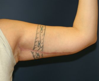 Arm Lift San Diego 12 - after - back