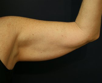 Arm Lift San Diego 14 - before - back