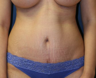 Tummy Tuck San Diego 58 - after - front