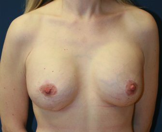 Breast-Lift-with-Implants-23 - after - front