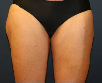 Liposuction Inner and Outer Thighs - after - back