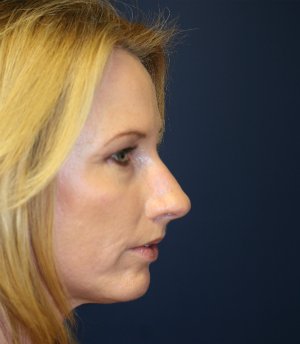 Rhinoplasty (Nose) Natural Change - before - front