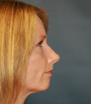 Rhinoplasty (Nose) Natural Change - after - front