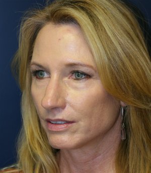 Rhinoplasty (Nose) Natural Change - before - oblique