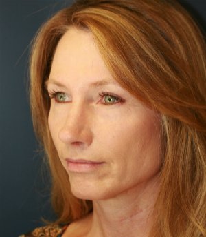 Rhinoplasty (Nose) Natural Change - after - oblique