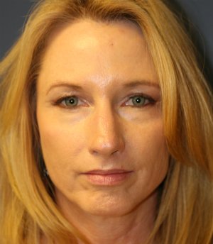 Rhinoplasty (Nose) Natural Change - before - side