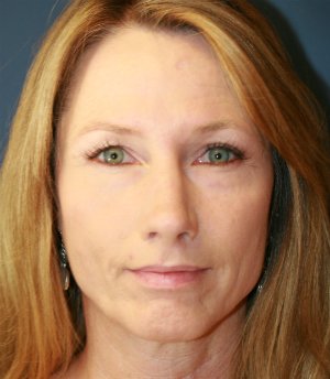 Rhinoplasty (Nose) Natural Change - after - side