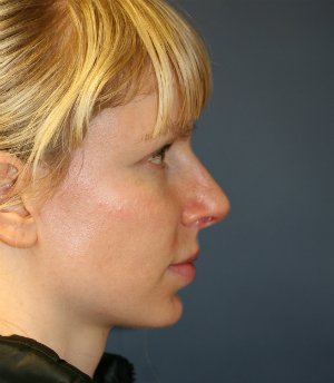 Rhinoplasty San Diego 111 - before - front