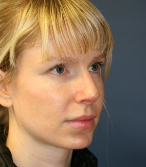 Rhinoplasty San Diego 111 - before - oblique