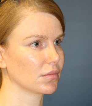 Rhinoplasty San Diego 111 - after - oblique