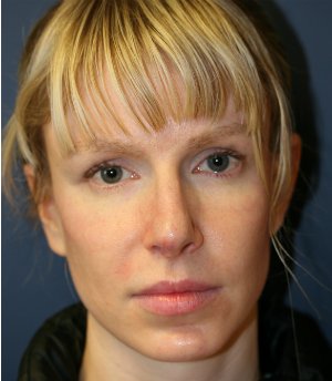 Rhinoplasty San Diego 111 - before - side