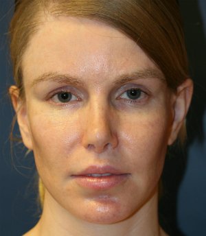 Rhinoplasty San Diego 111 - after - side