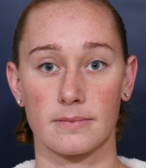 Straightening Crooked Nose - before - front