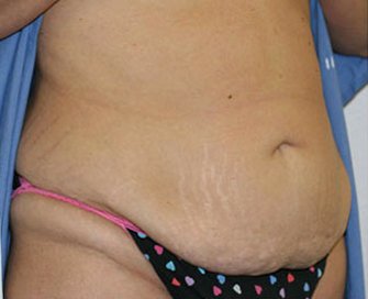 Tummy Tuck Case 1 - before - angle