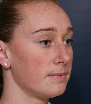 Straightening Crooked Nose - before - oblique